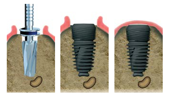 Implants dentaires Chalon sur Saone